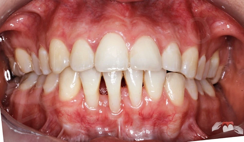 Kỹ thuật ghép ngầm 3D mô mềm