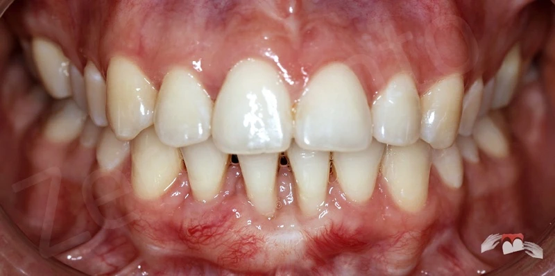 Kỹ thuật ghép ngầm 3D mô mềm