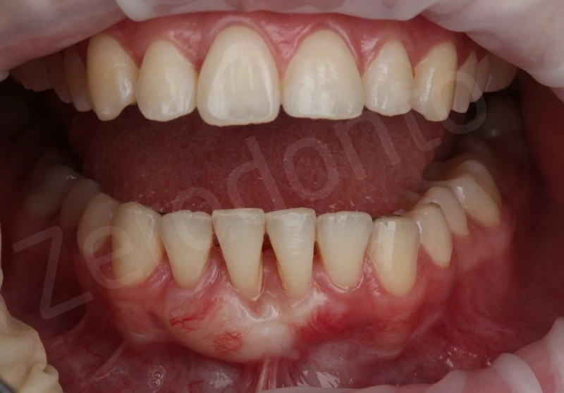 Kỹ thuật ghép ngầm 3D mô mềm