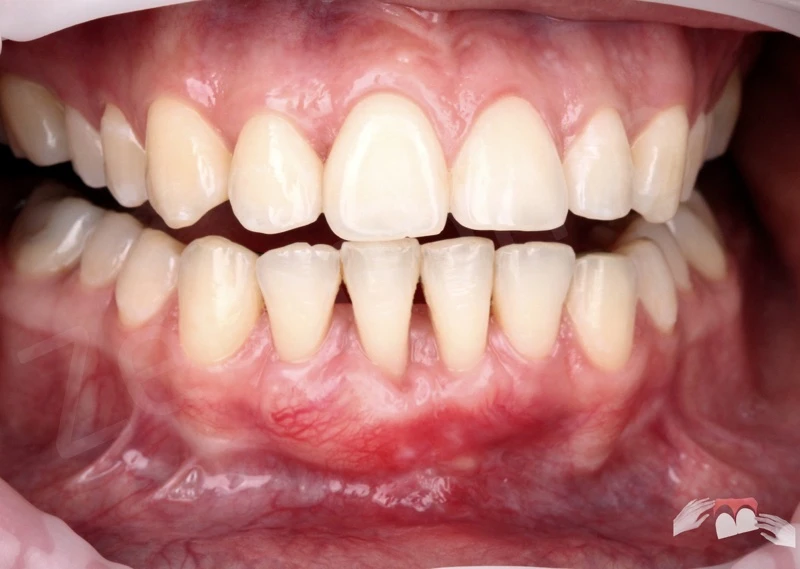 Kỹ thuật ghép ngầm 3d mô mềm – (3d soft tissue tunneling plasty procedure – 3d STP)