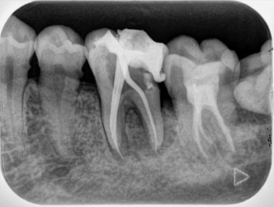 máy quét phim nha khoa