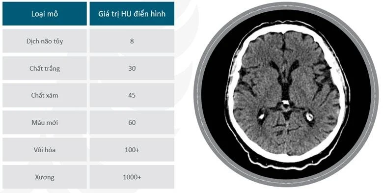 Các giá trị HU điển hình