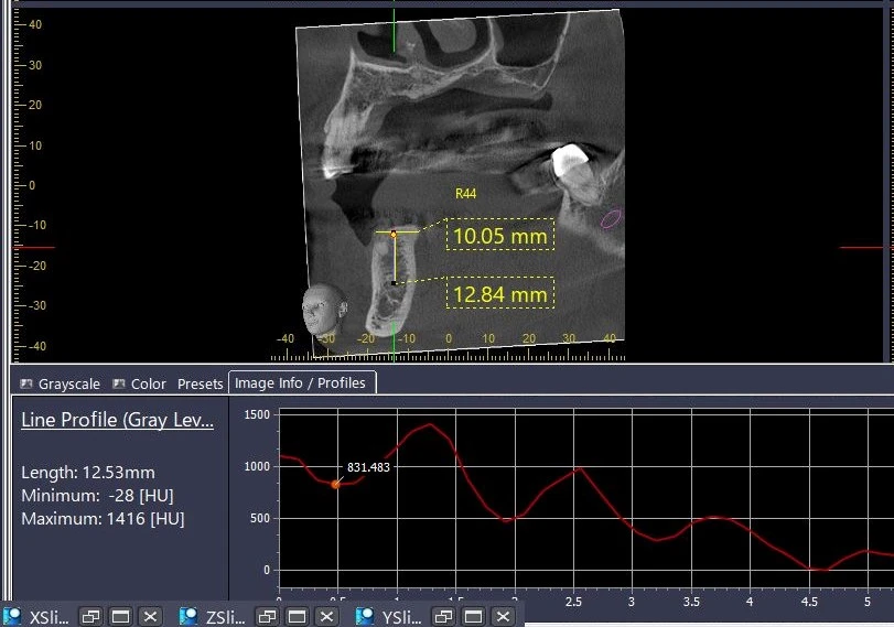 Đo HU bởi phần mềm i-Dixel