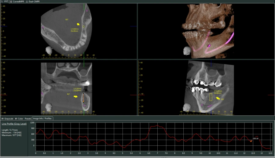 Đo chỉ số HU bởi phần mềm i-Dixel (2)