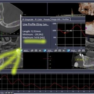 Đo chỉ số HU bởi phần mềm i-Dixel (3)