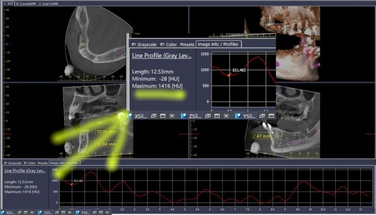 Đo chỉ số HU bởi phần mềm i-Dixel (3)