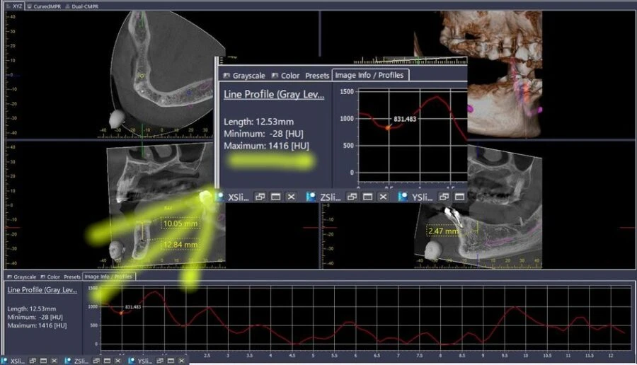 Đo chỉ số HU bởi phần mềm i-Dixel (3)