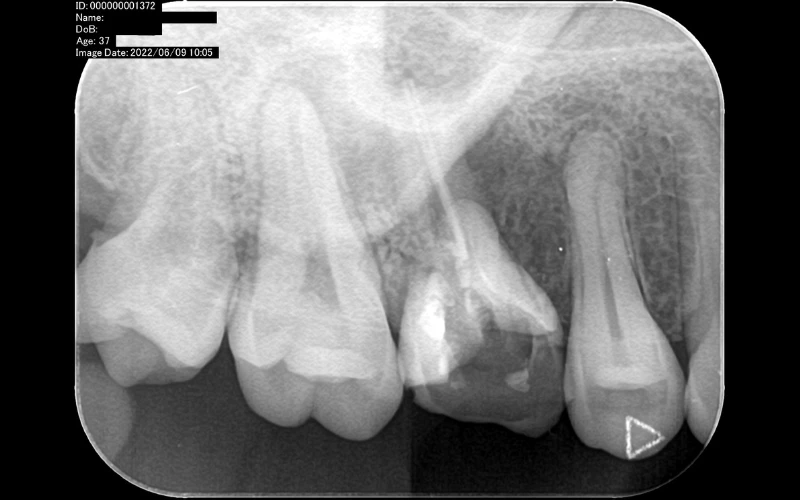 Phim cận chóp Morita