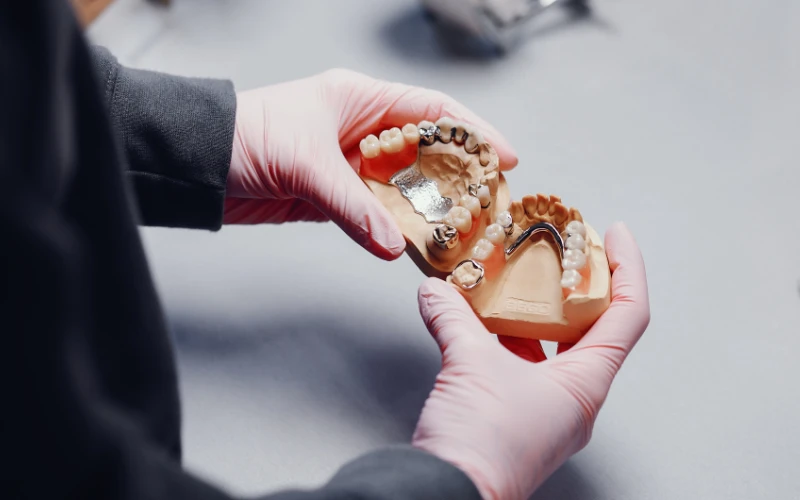 Bạn sẽ cần lấy dấu răng nhiều lần cho bệnh nhân chỉnh nha