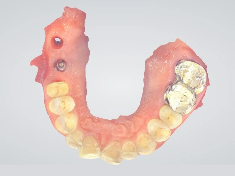 Hàm dưới cắm trụ và bọc kim loại