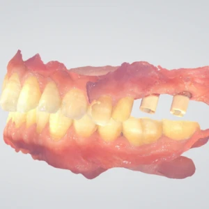 Khớp cắn với trụ kim loại