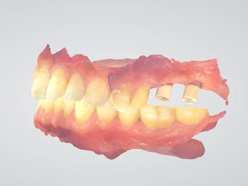 Khớp cắn với trụ kim loại