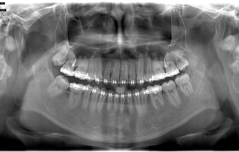 Phim toàn cảnh chụp bởi X-quang IC5 HD Morita