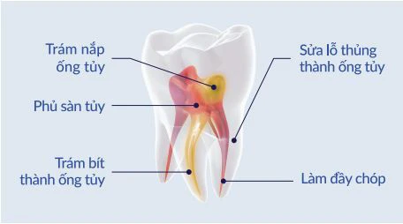 vật liệu trám bít ống tủy chứa thủy tinh sinh học được chỉ định rộng rãi trong ống tủy