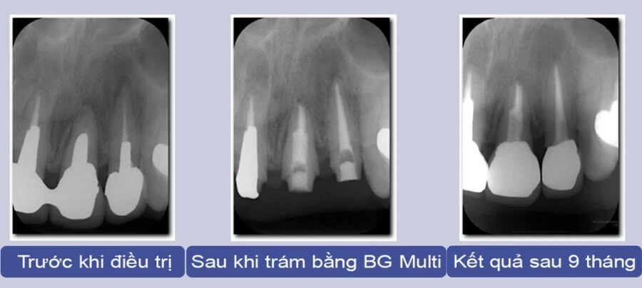 ca lâm sàng với vật liệu trám bít ống tủy BG Multi