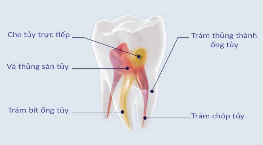 trám bít ống tủy