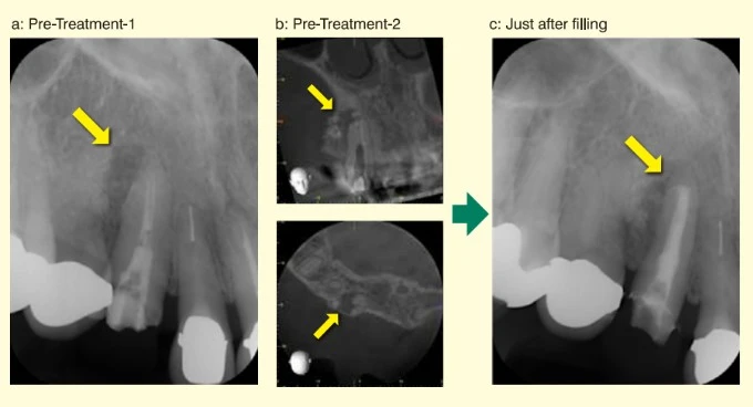 ứng dụng của vật liệu trám bít ống tủy BG Multi