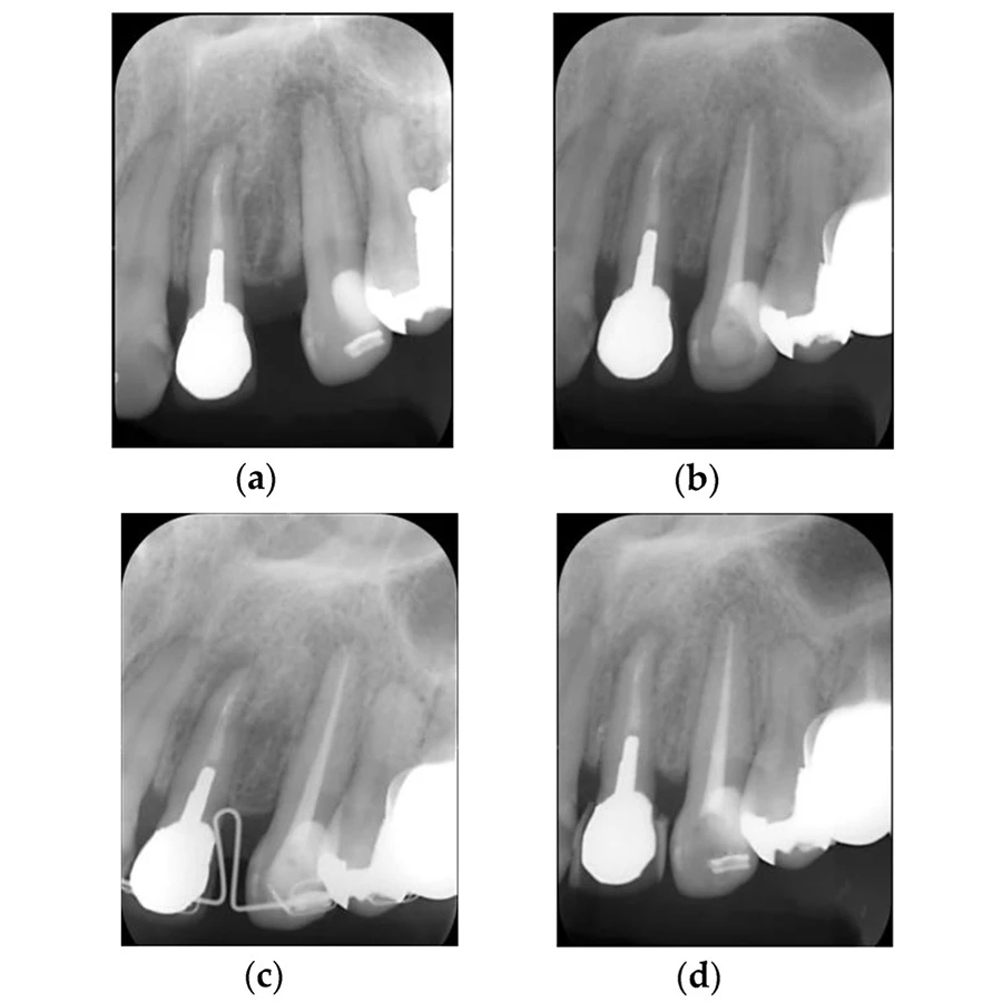 BG Multi giúp đẩy nhanh quá trình lành thương và tái tạo mô quanh chóp