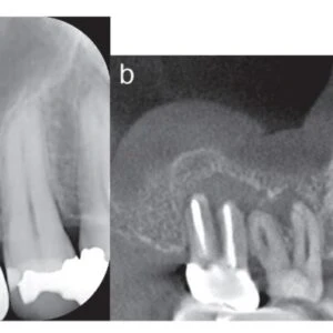 Ứng dụng của BG multi trong điều trị nội nha - các case lâm sàng