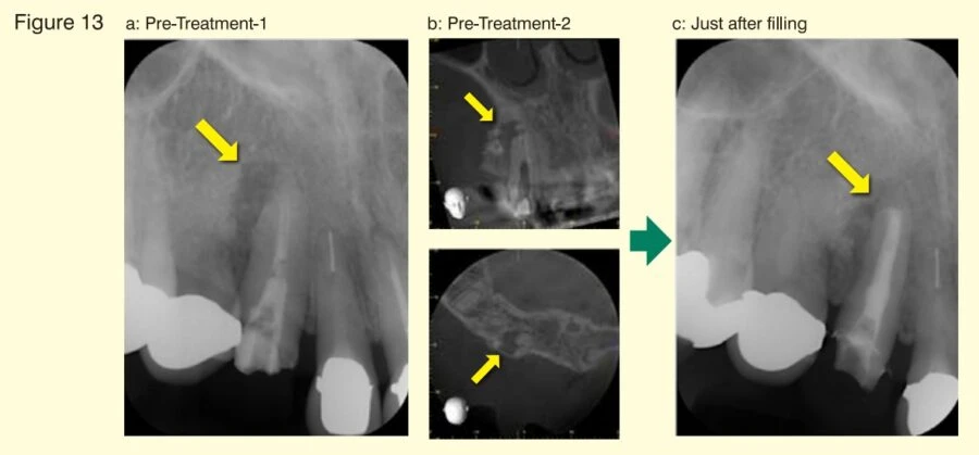BG Multi chứa thủy tinh sinh học 