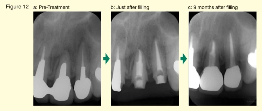 BG Multi chứa thủy tinh sinh học điều trị tổn thương quanh chóp 