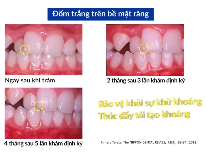 Nanoseal thay thế SDF ngừa sâu răng phát triển mà không làm đen răng