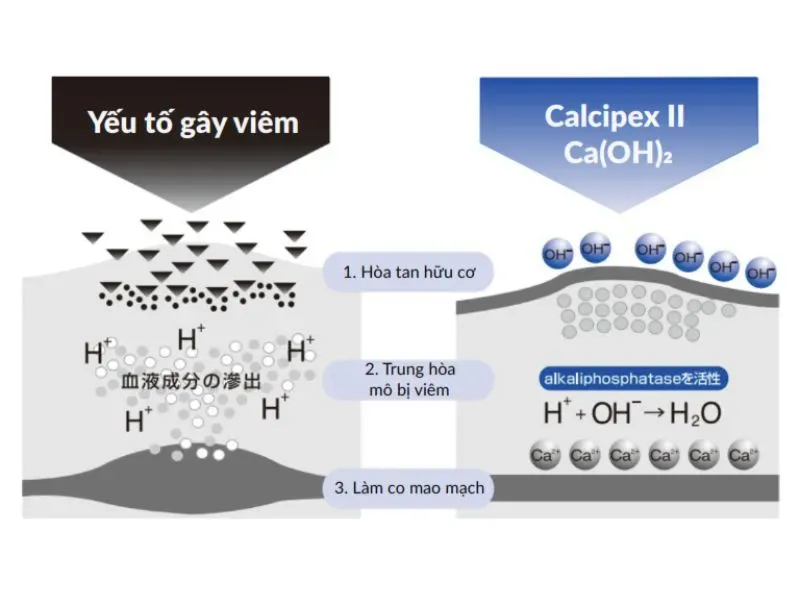 Calcipex II ngăn yếu tố gây viêm ống tủy