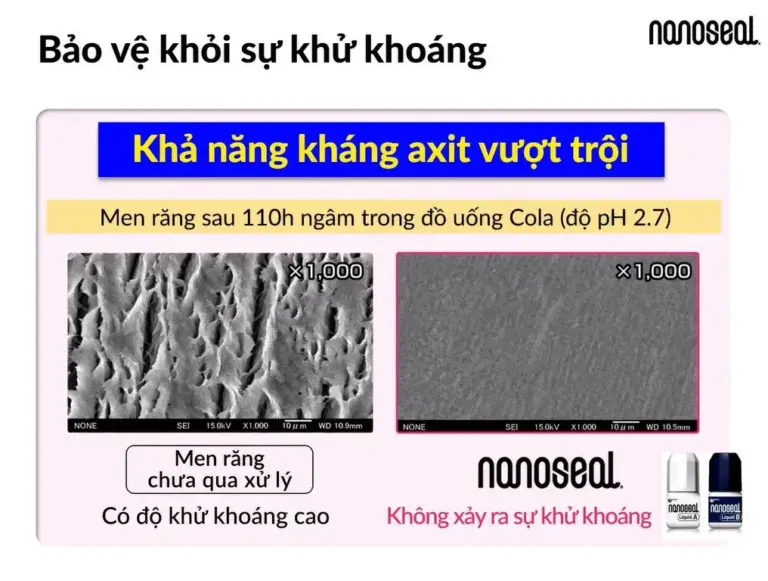 Nanoseal bảo vệ khỏi sự khử khoáng