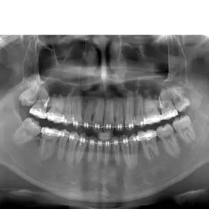 Phim X-quang toàn hàm chụp bởi IC5 Morita