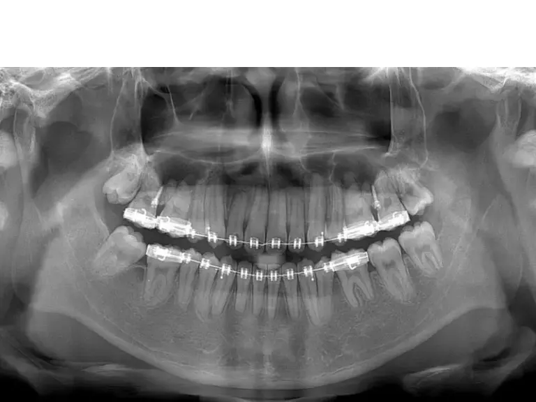 Phim X-quang toàn hàm chụp bởi IC5 Morita