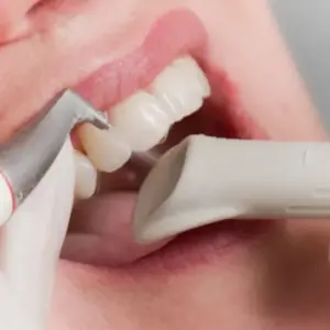 Quy trình lấy cao răng bằng máy thổi cát tại nha khoa - Lay cao rang bang may thoi cat