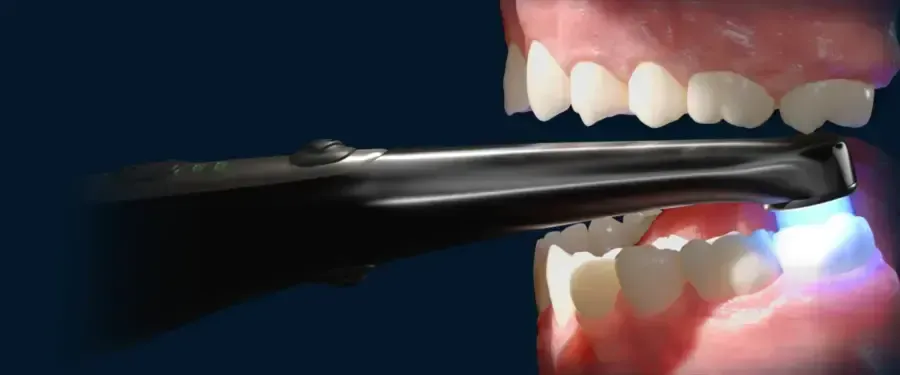 Công dụng của đèn quang trùng hợp là hỗ trợ đông kết chất trám