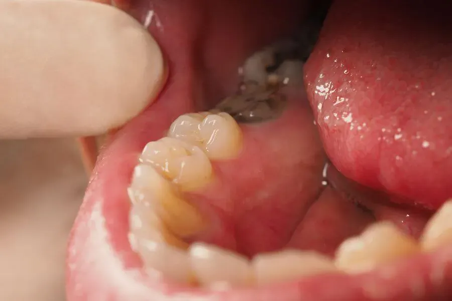 nguyên nhân sâu răng