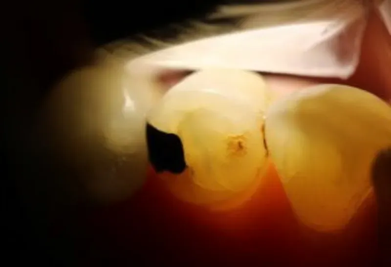 đèn trám phát hiện sâu răng