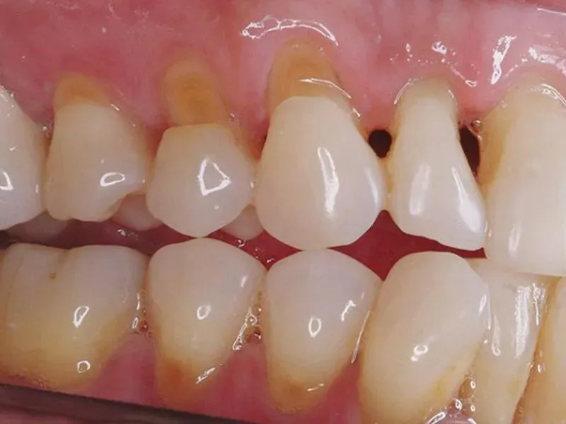 mòn cổ chân răng