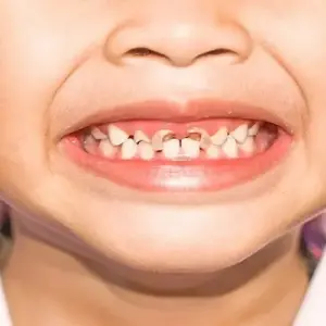 phòng tránh sâu răng ở trẻ