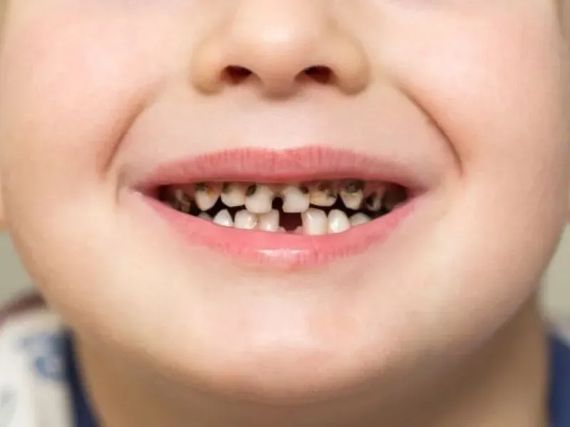 Cách ngừa sâu răng không làm đổi màu răng ở trẻ em - Cach ngua sau rang