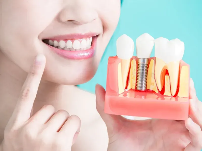 trồng răng implant giá rẻ
