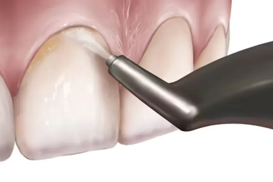 Quy trình thổi cát nha khoa