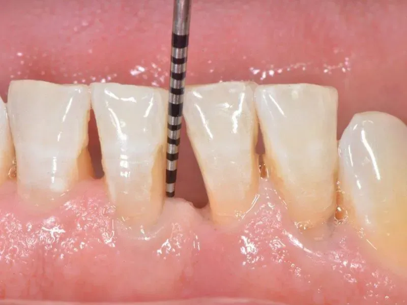 mòn cổ chân răng