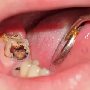 tình trạng sâu răng