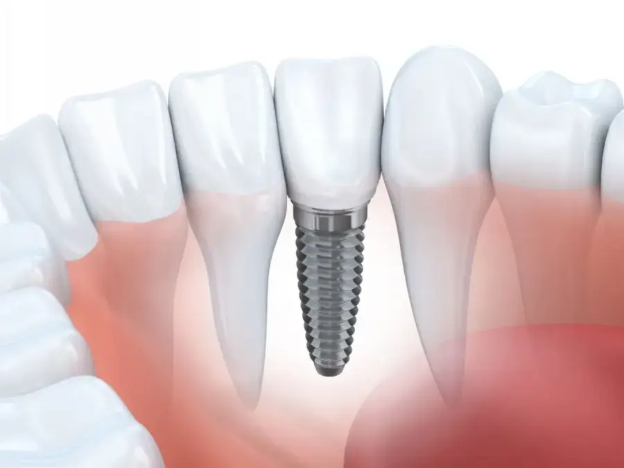 cấy ghép implant