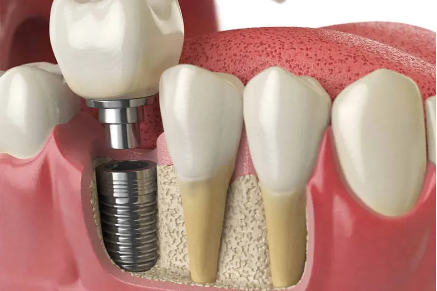 Trồng răng Implant