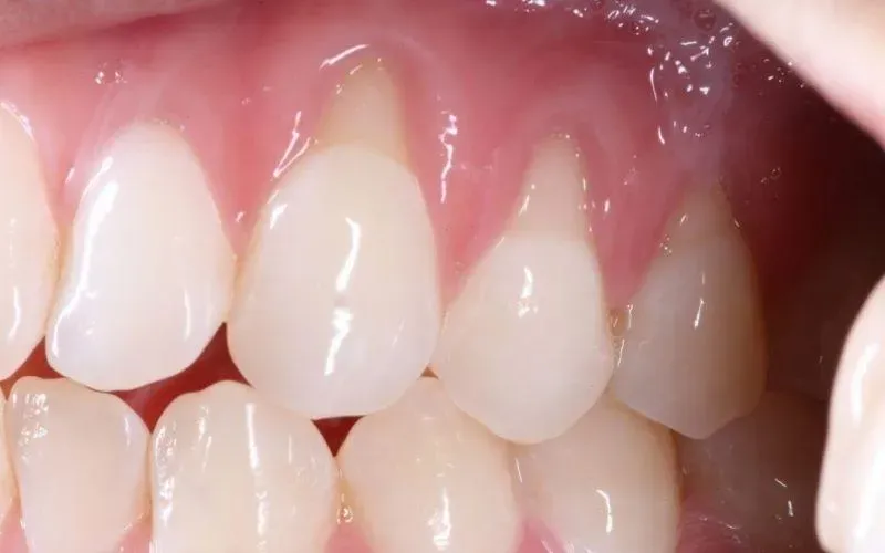 Mòn cổ răng là gì? nguyên nhân mòn cổ răng