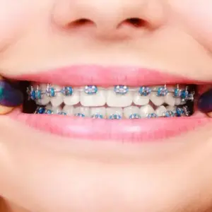 lưu ý cho người niềng