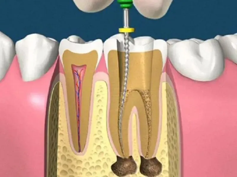 Máy rung rửa siêu âm nội nha là gì?
