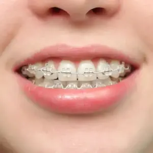 phương pháp niềng răng