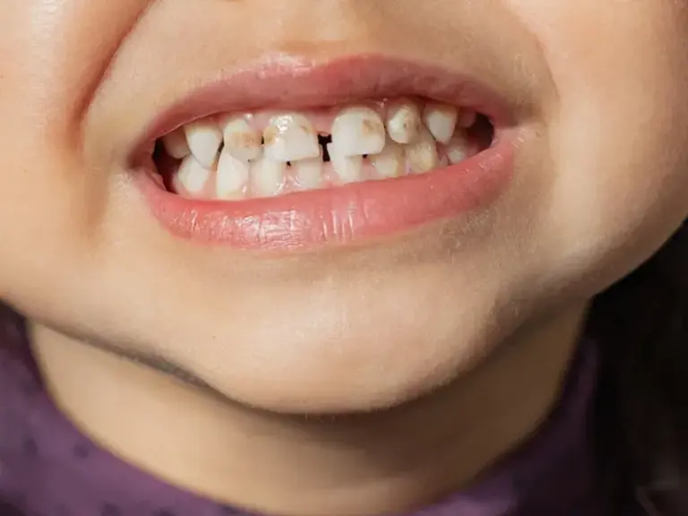 hậu quả của sâu răng sữa