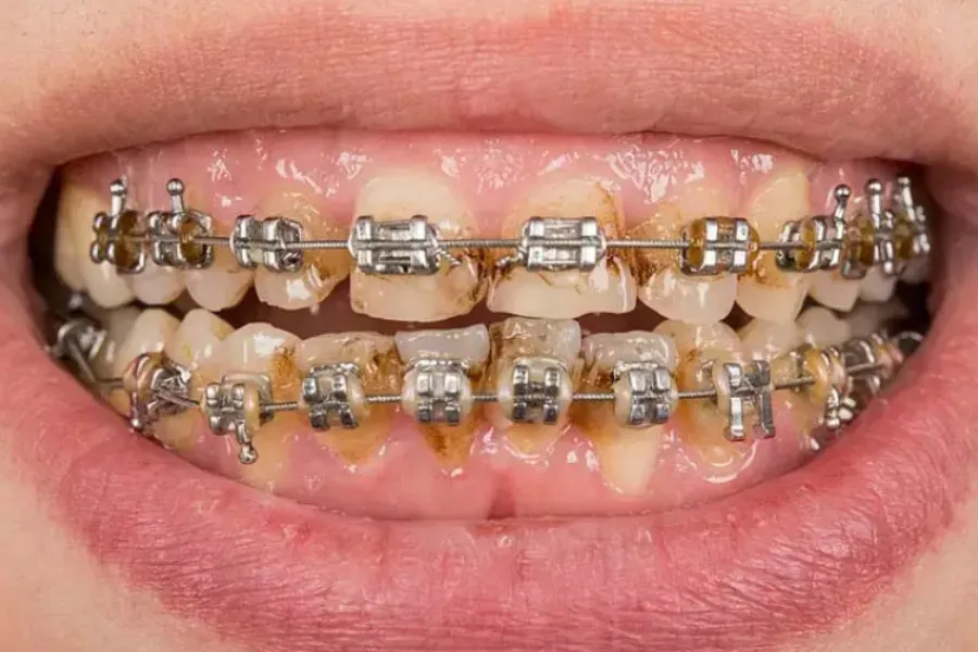 răng bị ố vàng