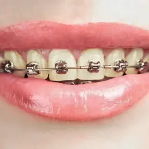 răng bị xỉn màu